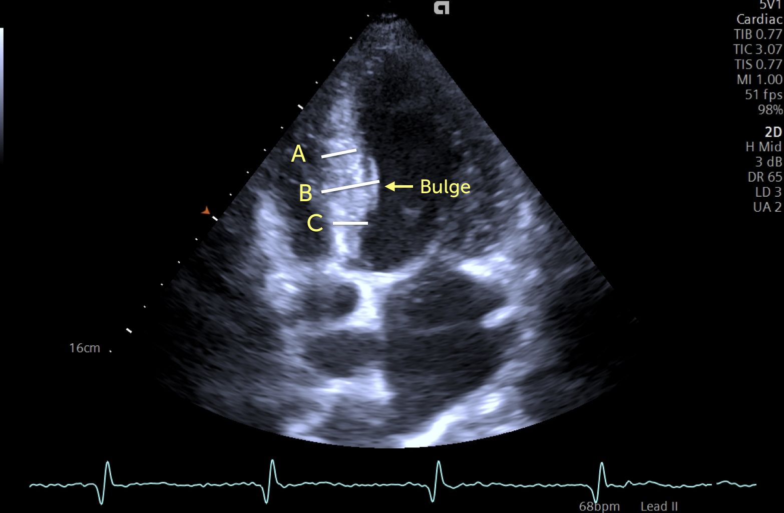 Figure From Quantification Of Left Ventricular Hypertrophy Off